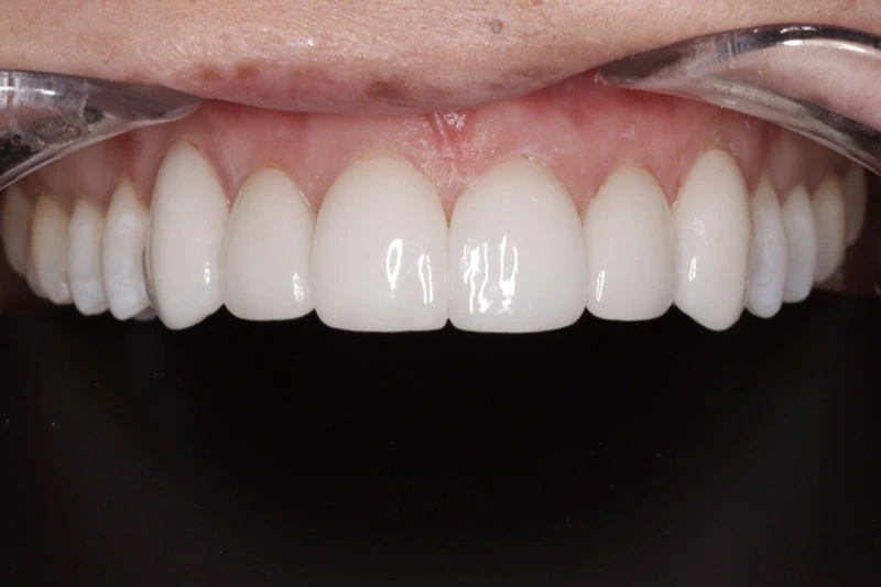 Veneers after