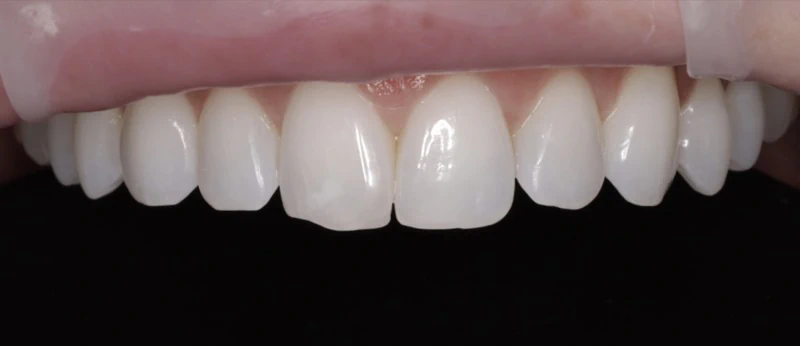 Veneers before